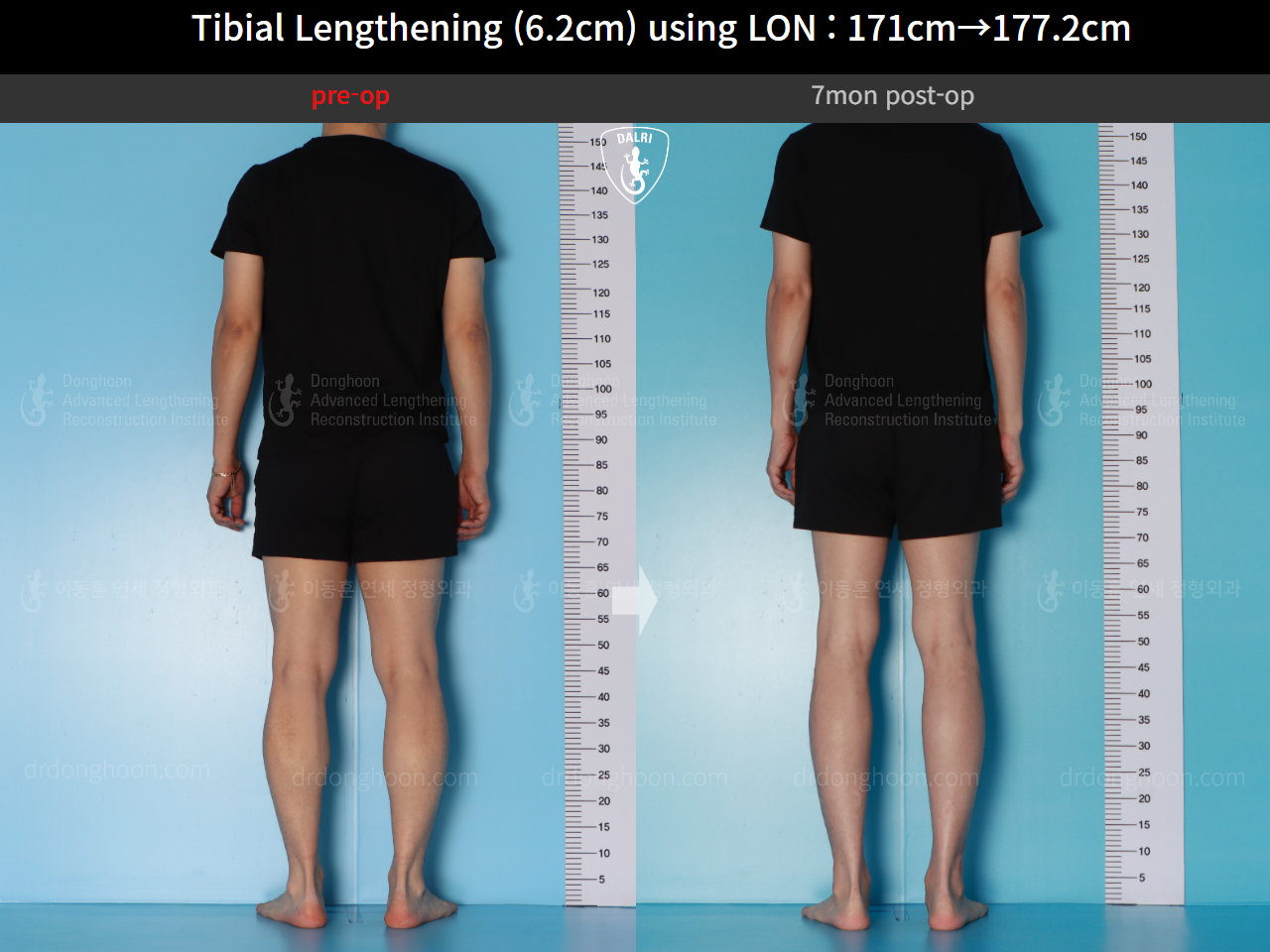 Before and after cll lon, case 16713373, image 4, Dr. Donghoon institute (DALRI)