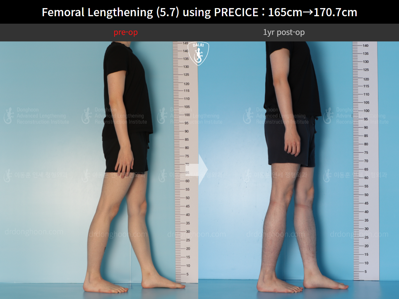 Before and after cll precice, case 15417090, image 4, Dr. Donghoon institute (DALRI)