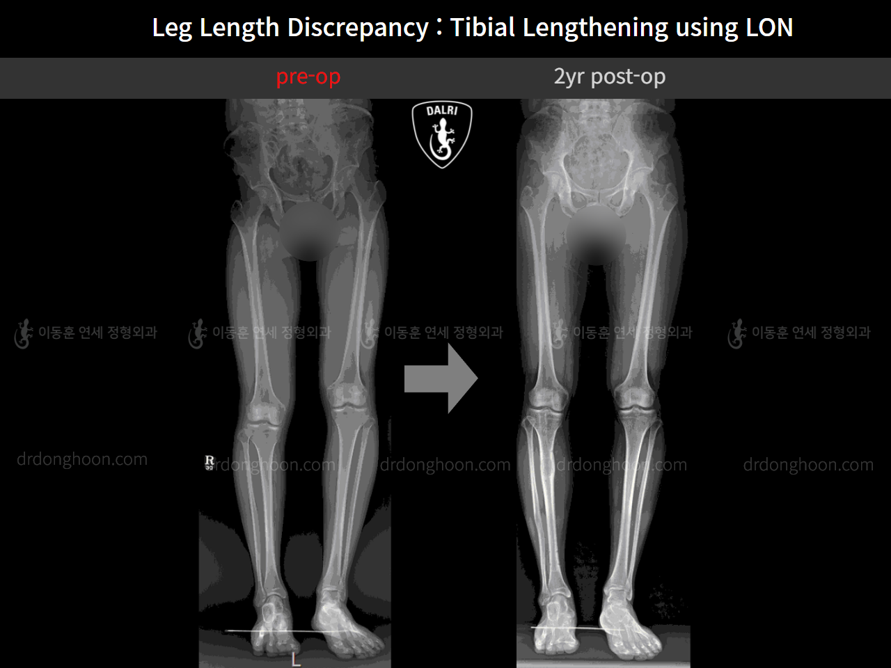 Before and after adult lld, case 11651115, image 5, Dr. Donghoon institute (DALRI)