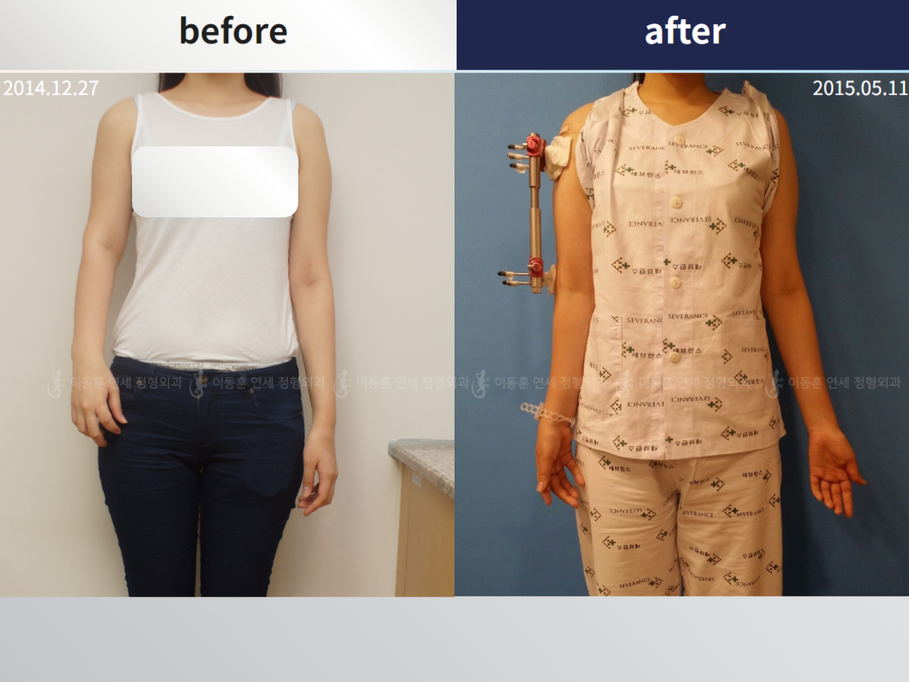 Before and after arm lengthening, case 4249385, image 1, Dr. Donghoon institute (DALRI)