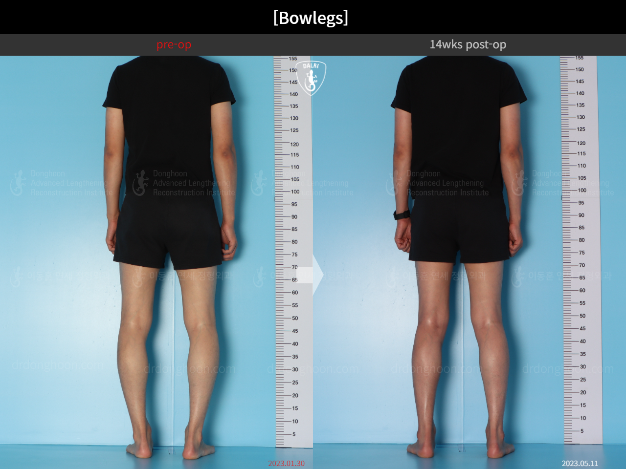 Before and after adult bowlegs, case 15512423, image 5, Dr. Donghoon institute (DALRI)