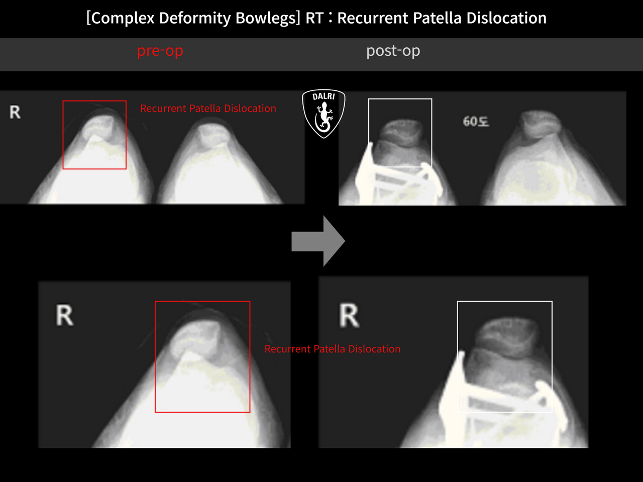 Before and after recurrent patella dislocation, case 12255234, image 8, Dr. Donghoon institute (DALRI)