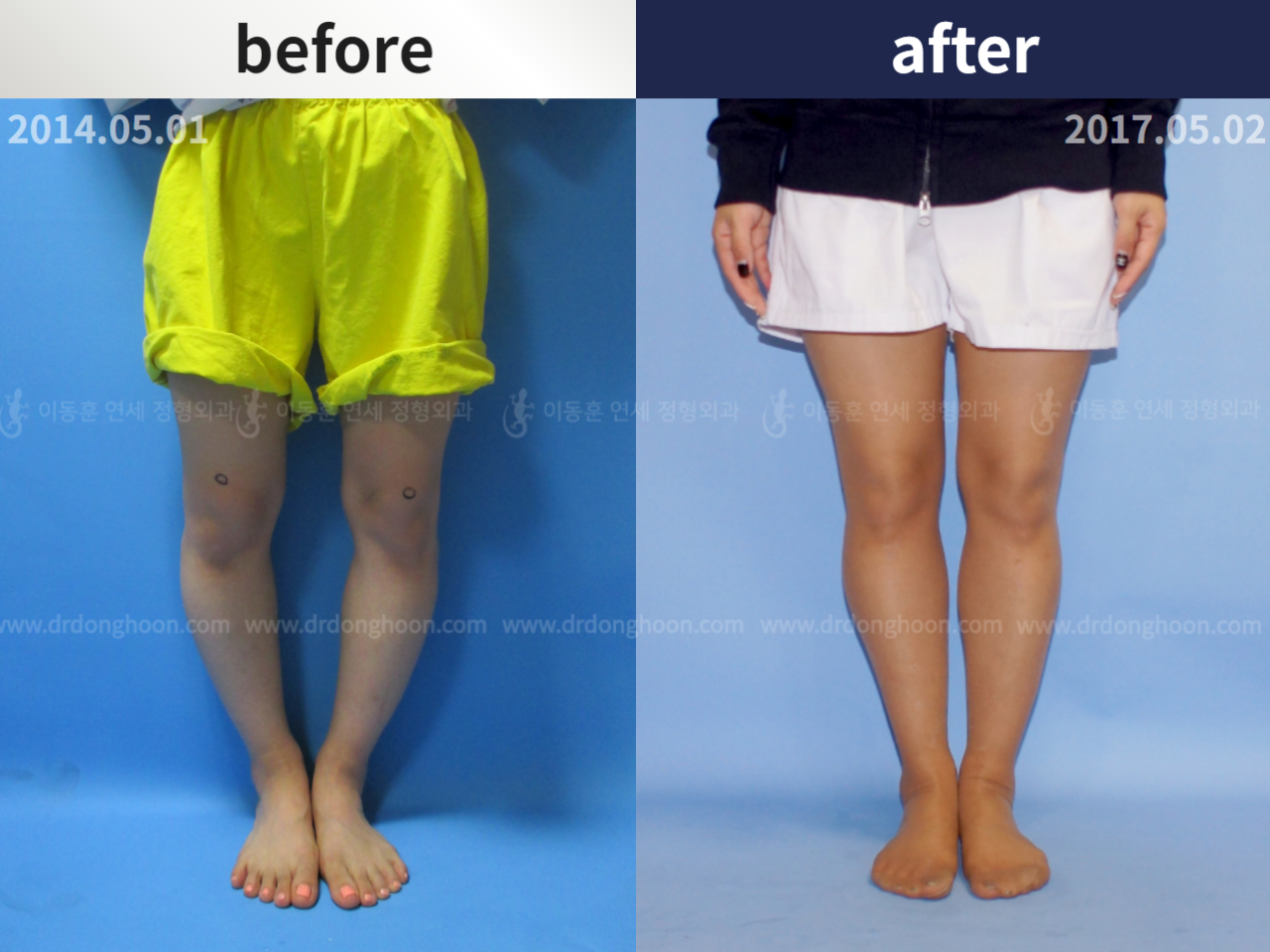 Before and after adult bowlegs, case 4764706, image 1, Dr. Donghoon institute (DALRI)