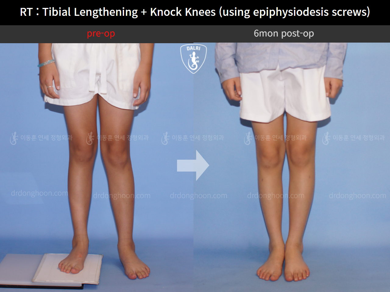 Before and after paediatric & adolescent lld, case 4320397, image 3, Dr. Donghoon institute (DALRI)