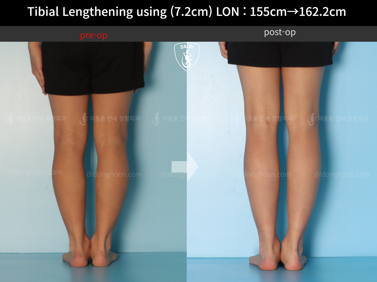 Before and after cll lon, case 13635674, image 8, Dr. Donghoon institute (DALRI)