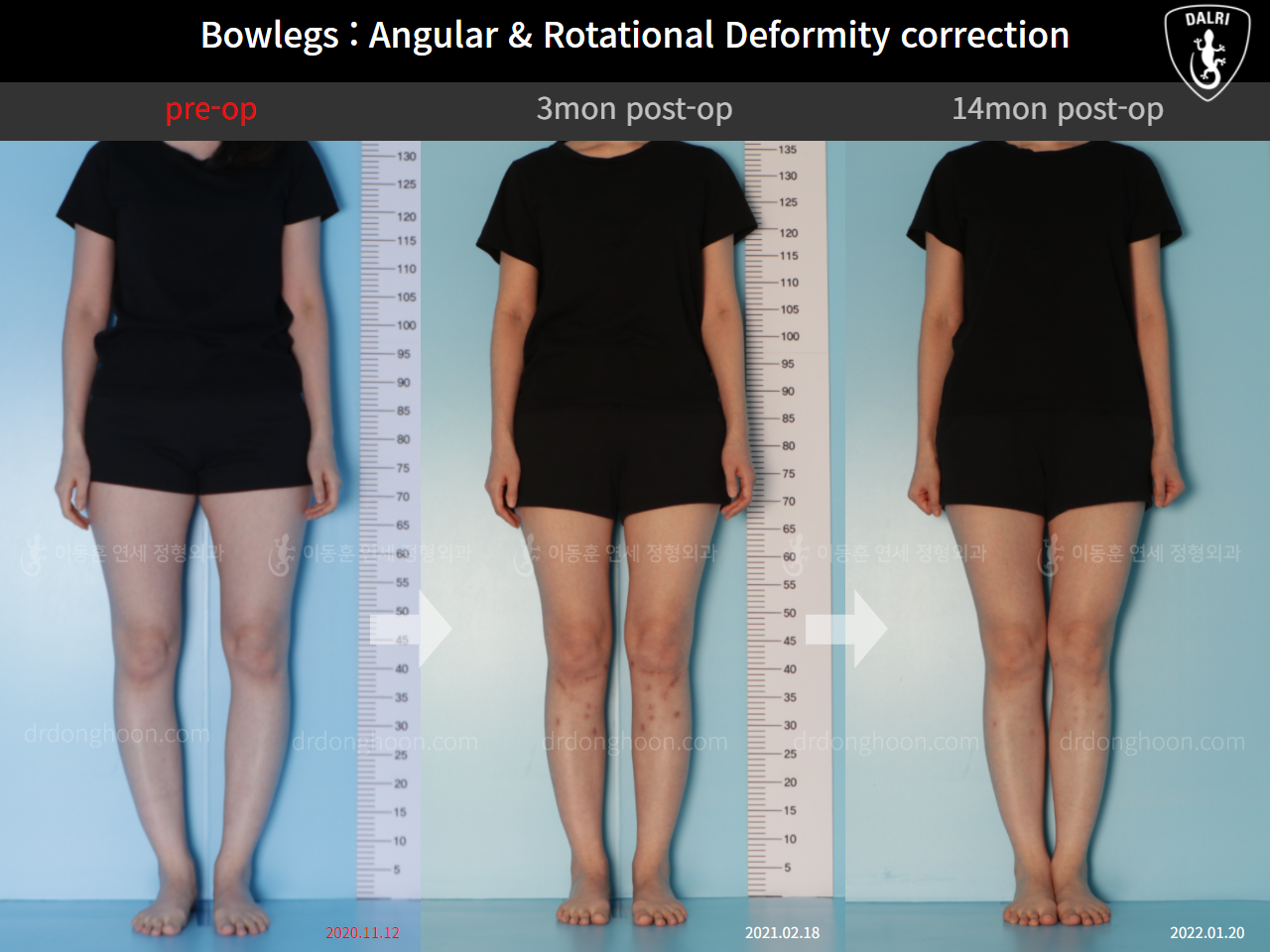 Before and after adult bowlegs, case 9557826, image 1, Dr. Donghoon institute (DALRI)