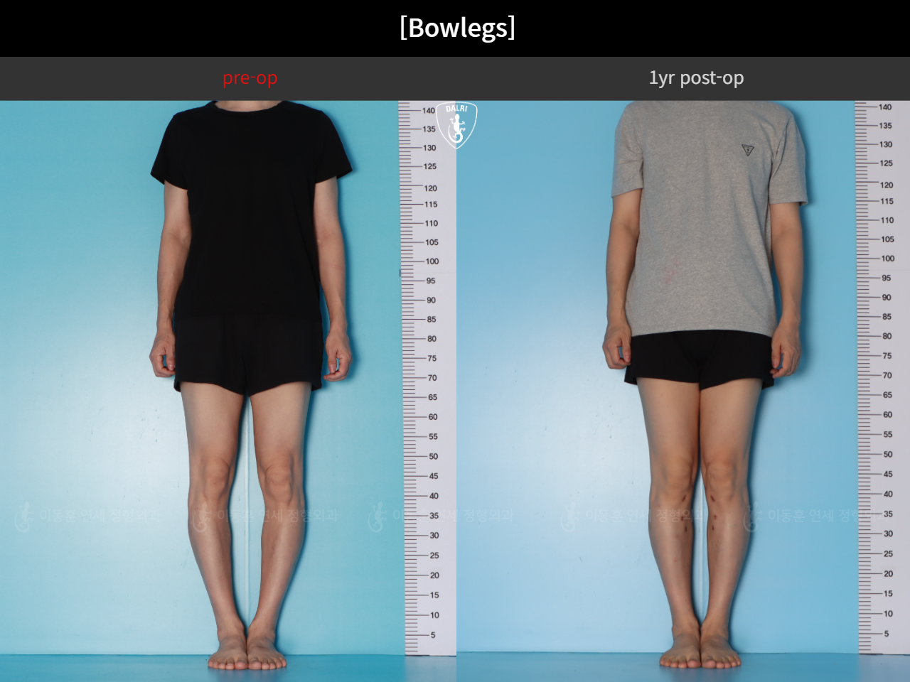 Before and after adult bowlegs, case 125438866, image 5, Dr. Donghoon institute (DALRI)