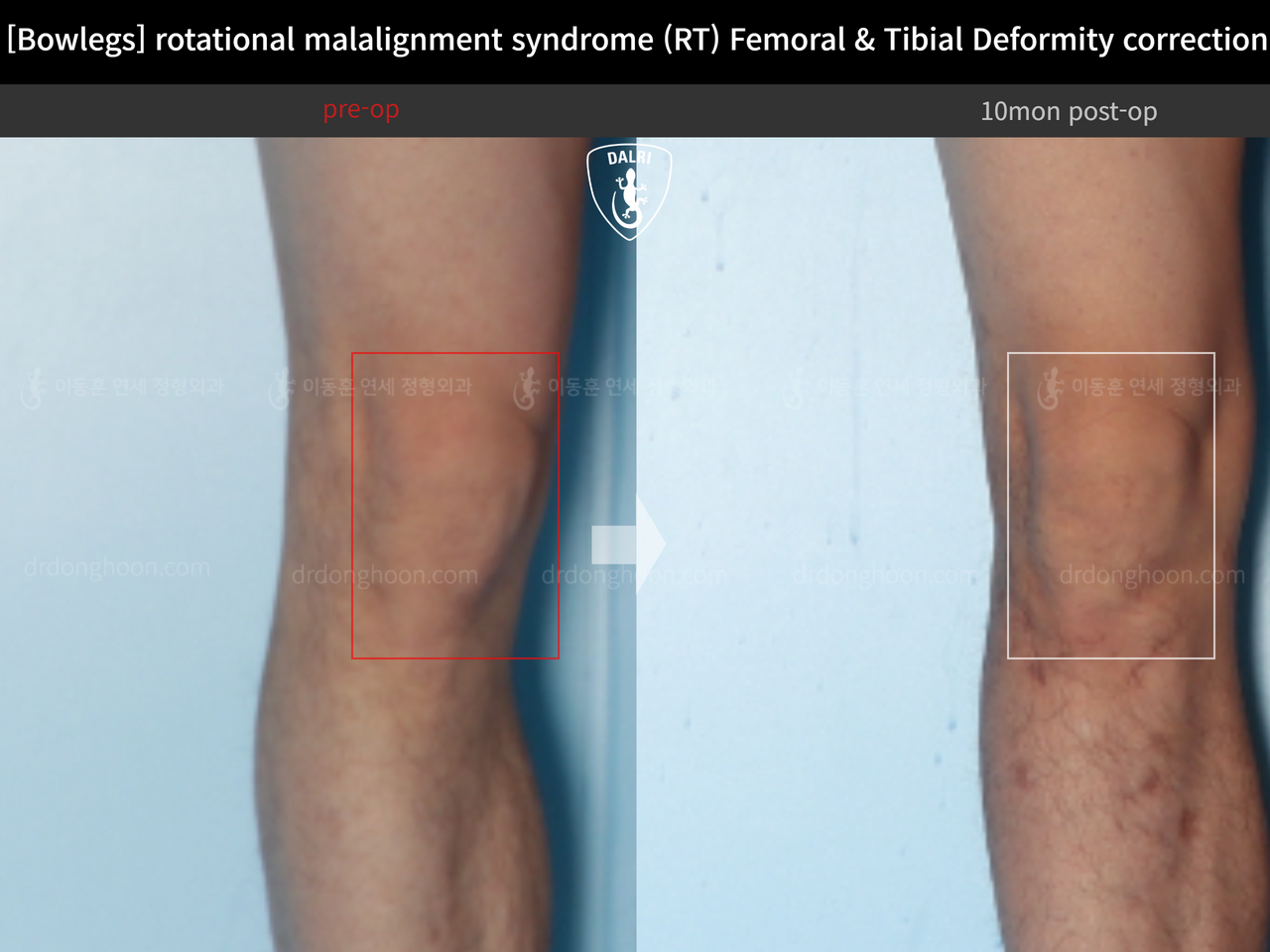 Before and after adult bowlegs, case 14220550, image 7, Dr. Donghoon institute (DALRI)