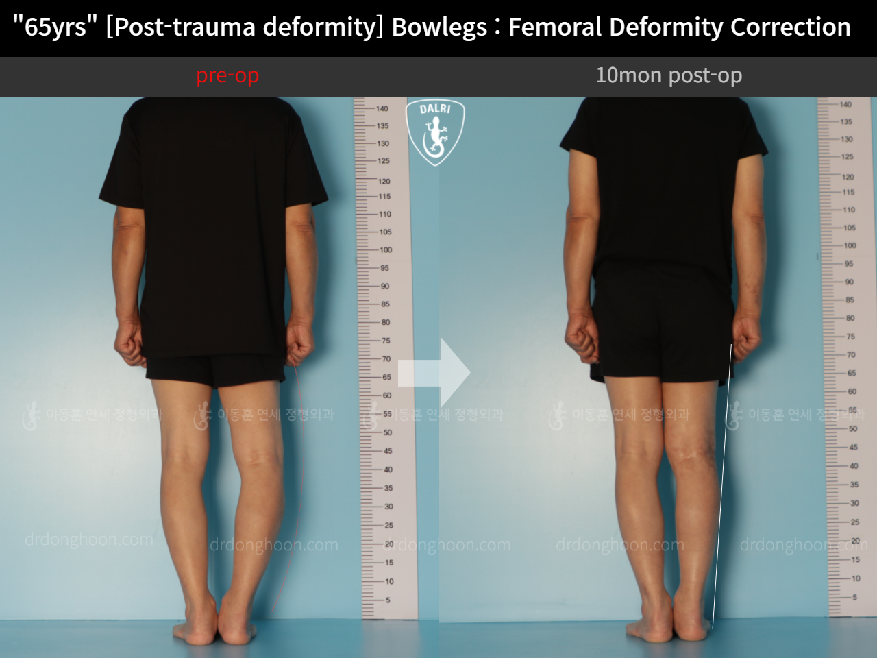 Before and after osteotomy for knee osteoarthritis, case 11675321, image 2, Dr. Donghoon institute (DALRI)