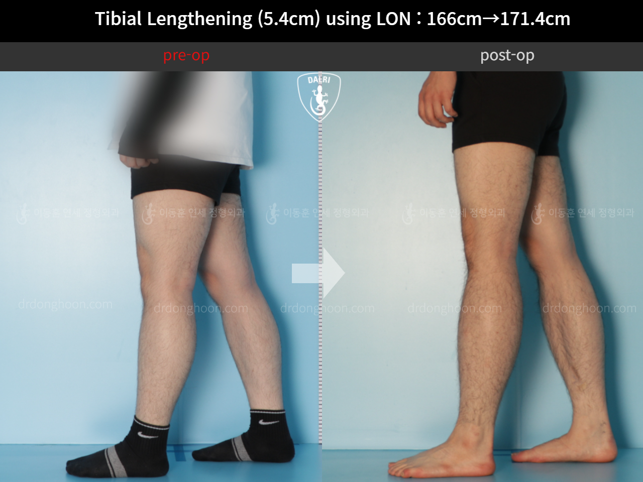 Before and after cll lon, case 11831572, image 7, Dr. Donghoon institute (DALRI)