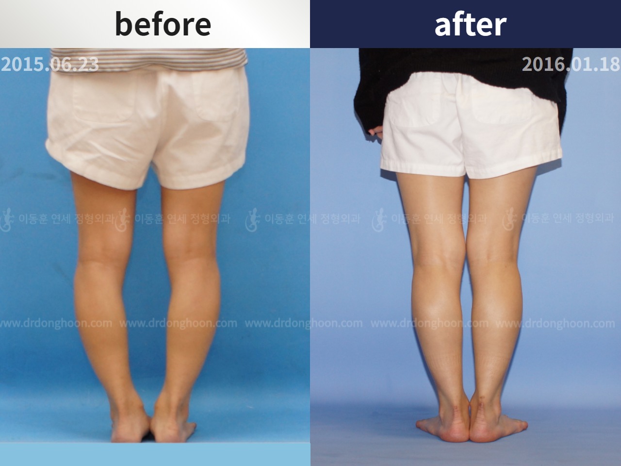 Before and after adult bowlegs, case 4311018, image 2, Dr. Donghoon institute (DALRI)