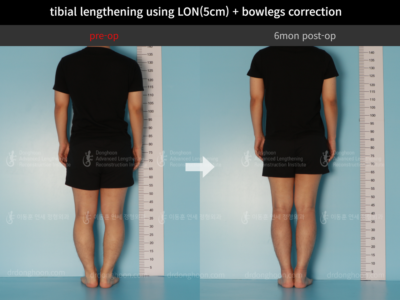 Before and after cll + deformity correction, case 11925306, image 2, Dr. Donghoon institute (DALRI)