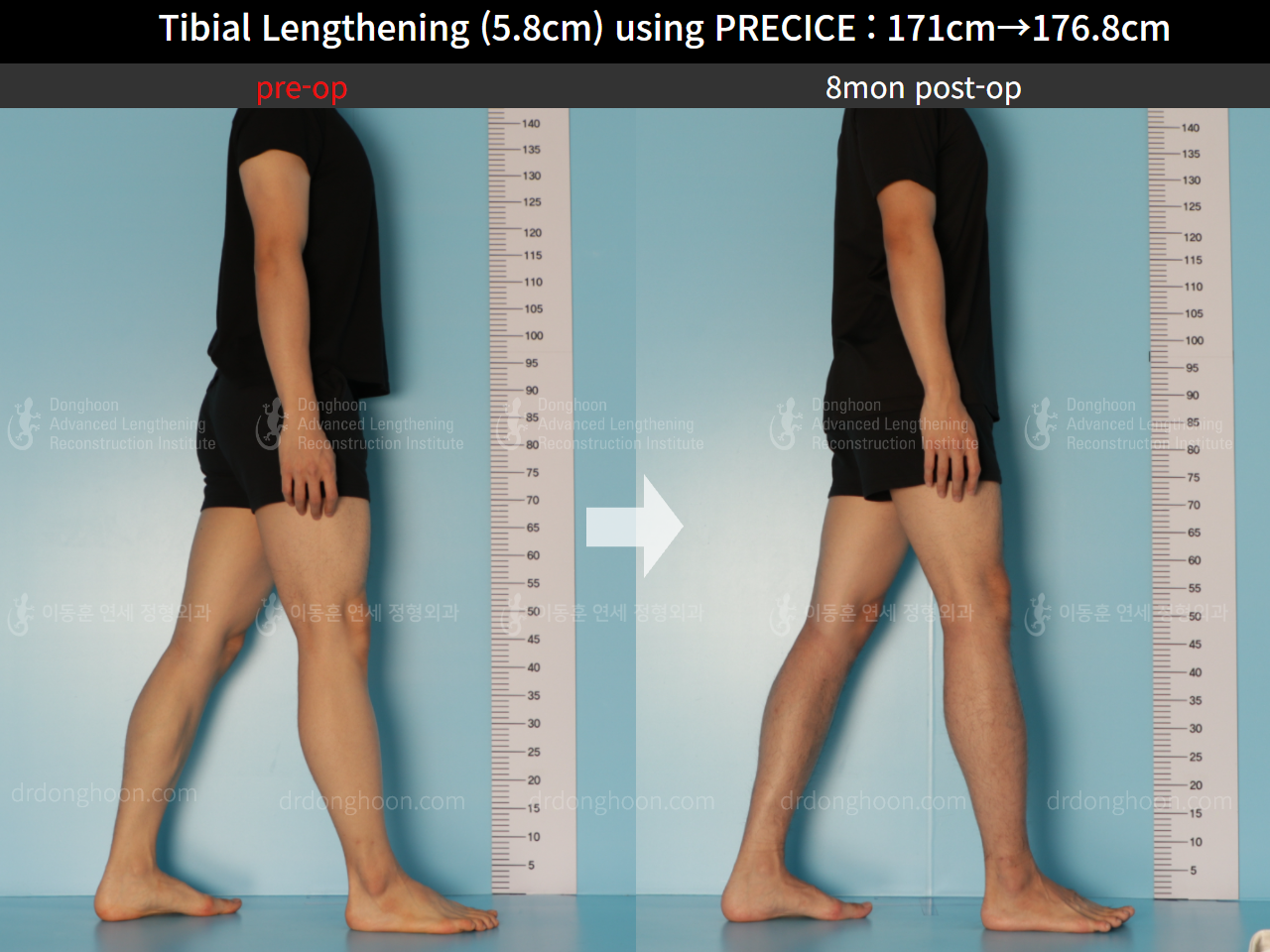 Before and after cll precice, case 8678696, image 4, Dr. Donghoon institute (DALRI)
