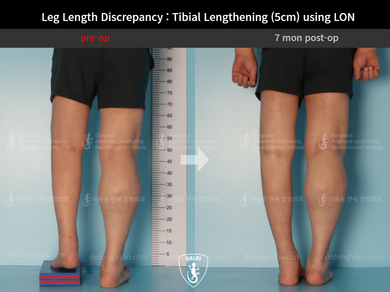 Before and after adult lld, case 9165807, image 6, Dr. Donghoon institute (DALRI)