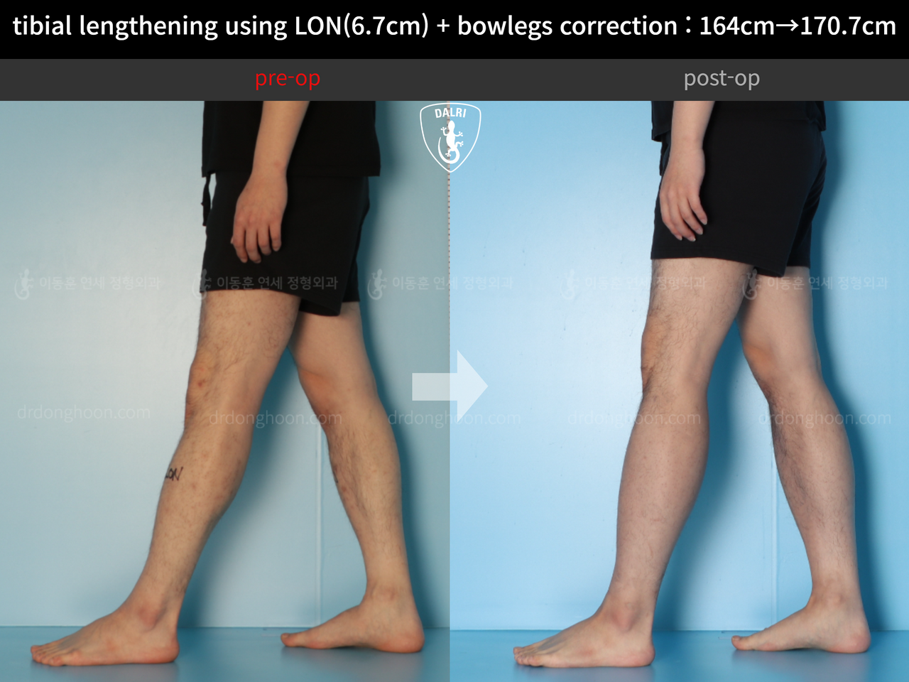 Before and after cll + deformity correction, case 13914972, image 10, Dr. Donghoon institute (DALRI)