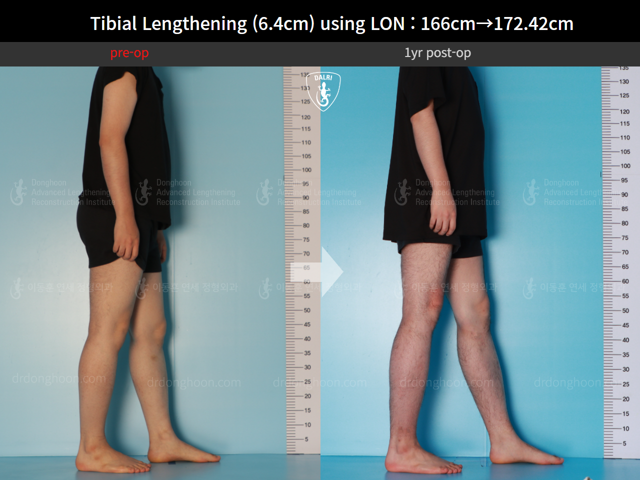 Before and after cll lon, case 15889727, image 4, Dr. Donghoon institute (DALRI)