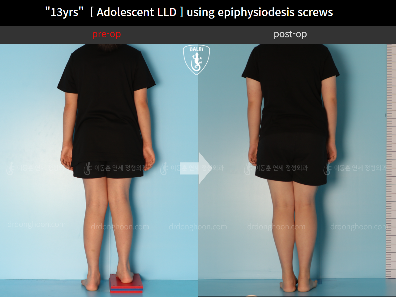 Before and after paediatric & adolescent lld, case 11773378, image 2, Dr. Donghoon institute (DALRI)