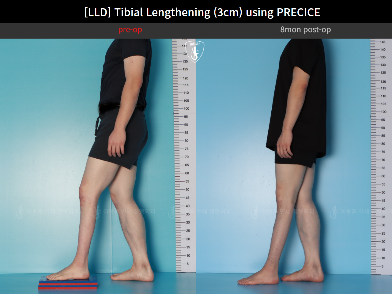 Before and after adult lld, case 124813877, image 3, Dr. Donghoon institute (DALRI)