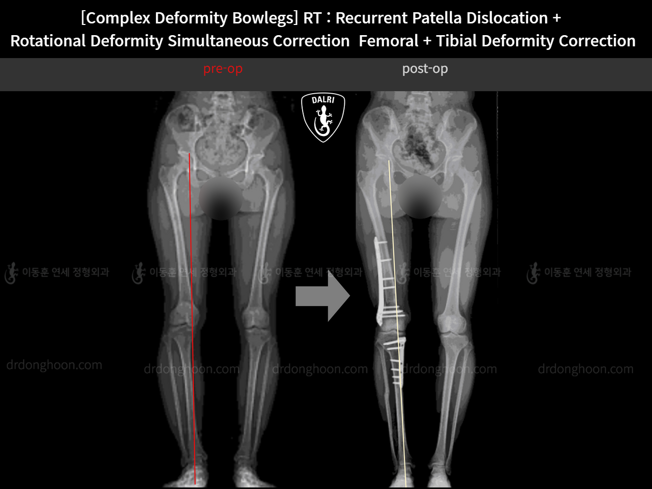 Before and after complex deformity, case 14960898, image 10, Dr. Donghoon institute (DALRI)