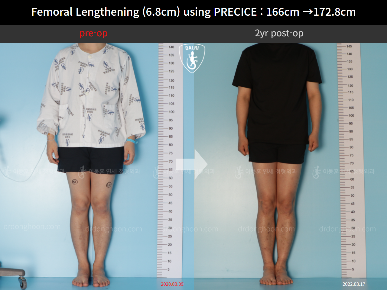 Before and after cll precice, case 10883099, image 1, Dr. Donghoon institute (DALRI)