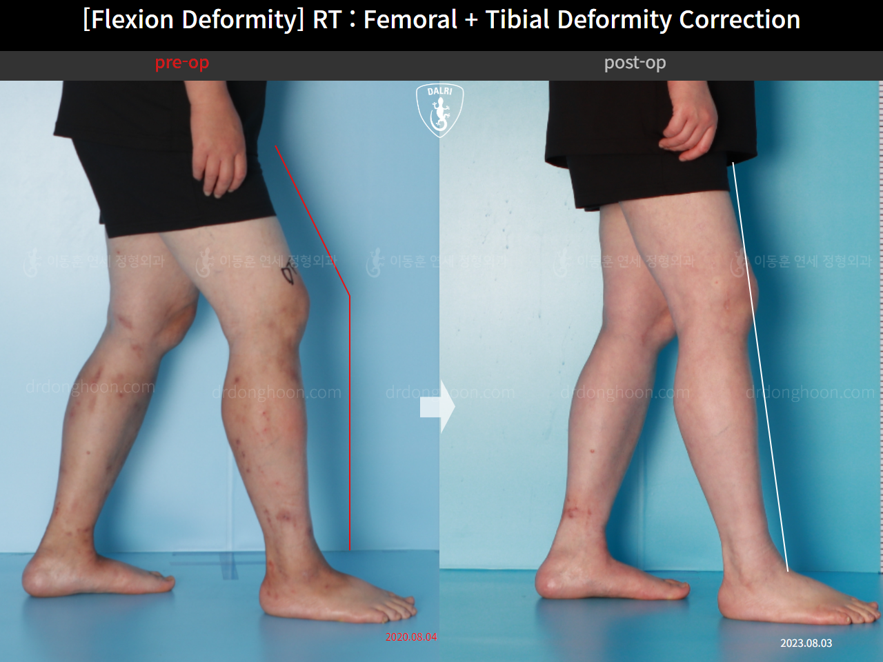 Before and after flexion deformity, case 15993081, image 4, Dr. Donghoon institute (DALRI)