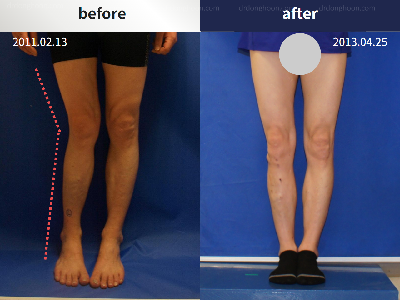 Before and after post-trauma deformity, case 4795628, image 1, Dr. Donghoon institute (DALRI)