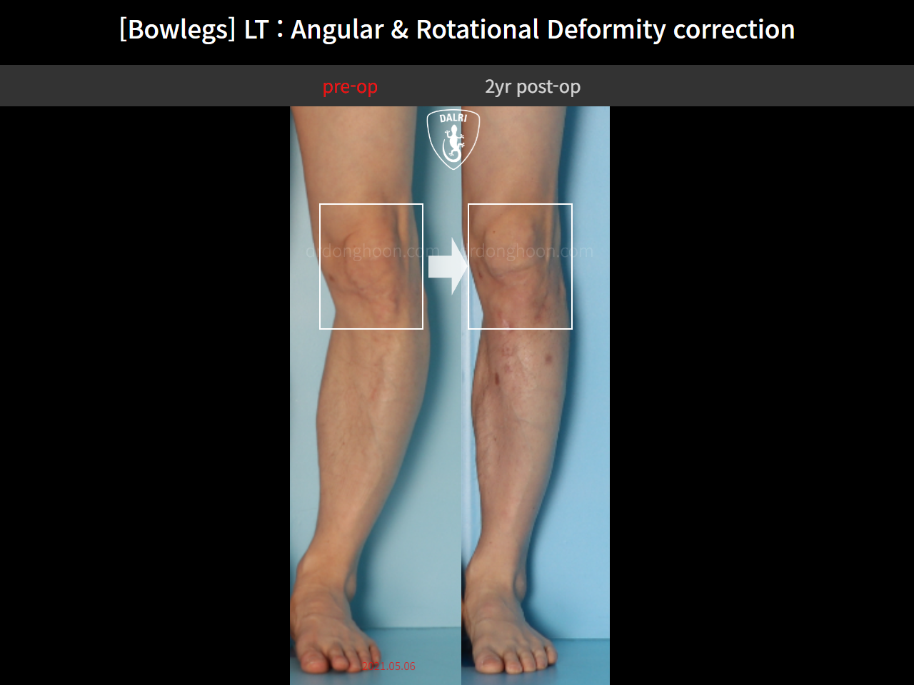 Before and after adult bowlegs, case 15111863, image 6, Dr. Donghoon institute (DALRI)