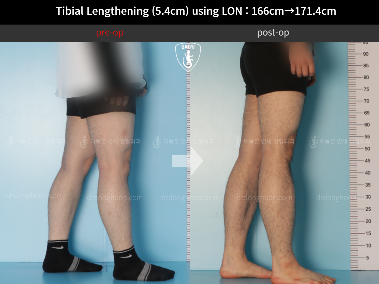 Before and after cll lon, case 11831572, image 8, Dr. Donghoon institute (DALRI)