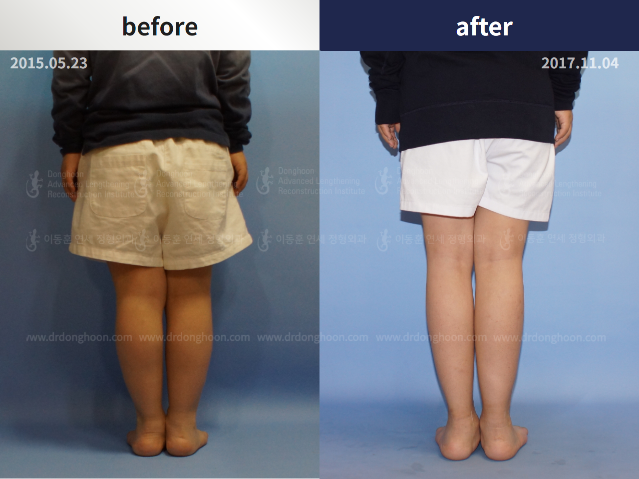 Before and after paediatric congenital condition, case 4304775, image 2, Dr. Donghoon institute (DALRI)