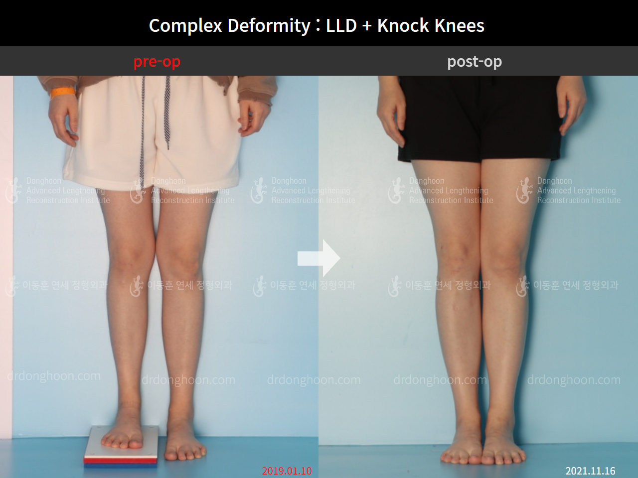 Before and after complex deformity, case 9041567, image 4, Dr. Donghoon institute (DALRI)