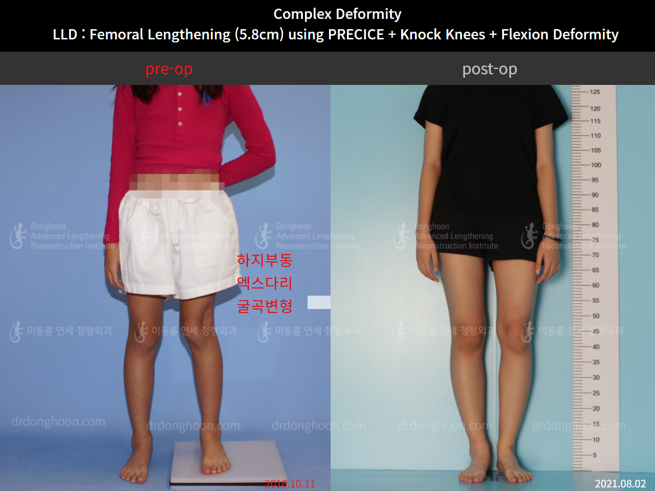 Before and after complex deformity, case 8790512, image 3, Dr. Donghoon institute (DALRI)