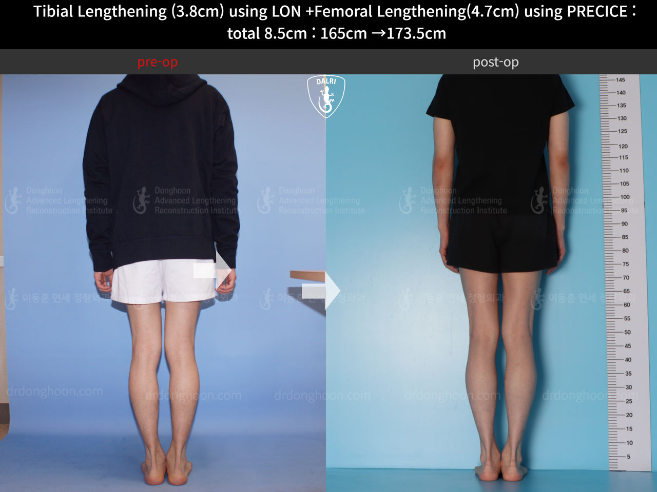 Before and after cll precice, case 4576980, image 6, Dr. Donghoon institute (DALRI)