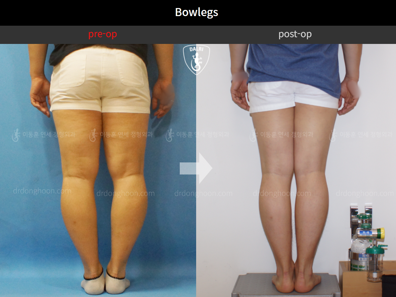 Before and after adult bowlegs, case 4311035, image 4, Dr. Donghoon institute (DALRI)