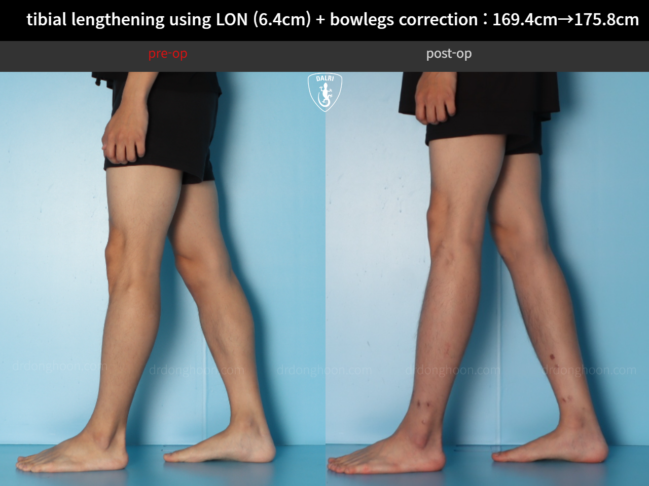 Before and after cll + deformity correction, case 36736776, image 10, Dr. Donghoon institute (DALRI)