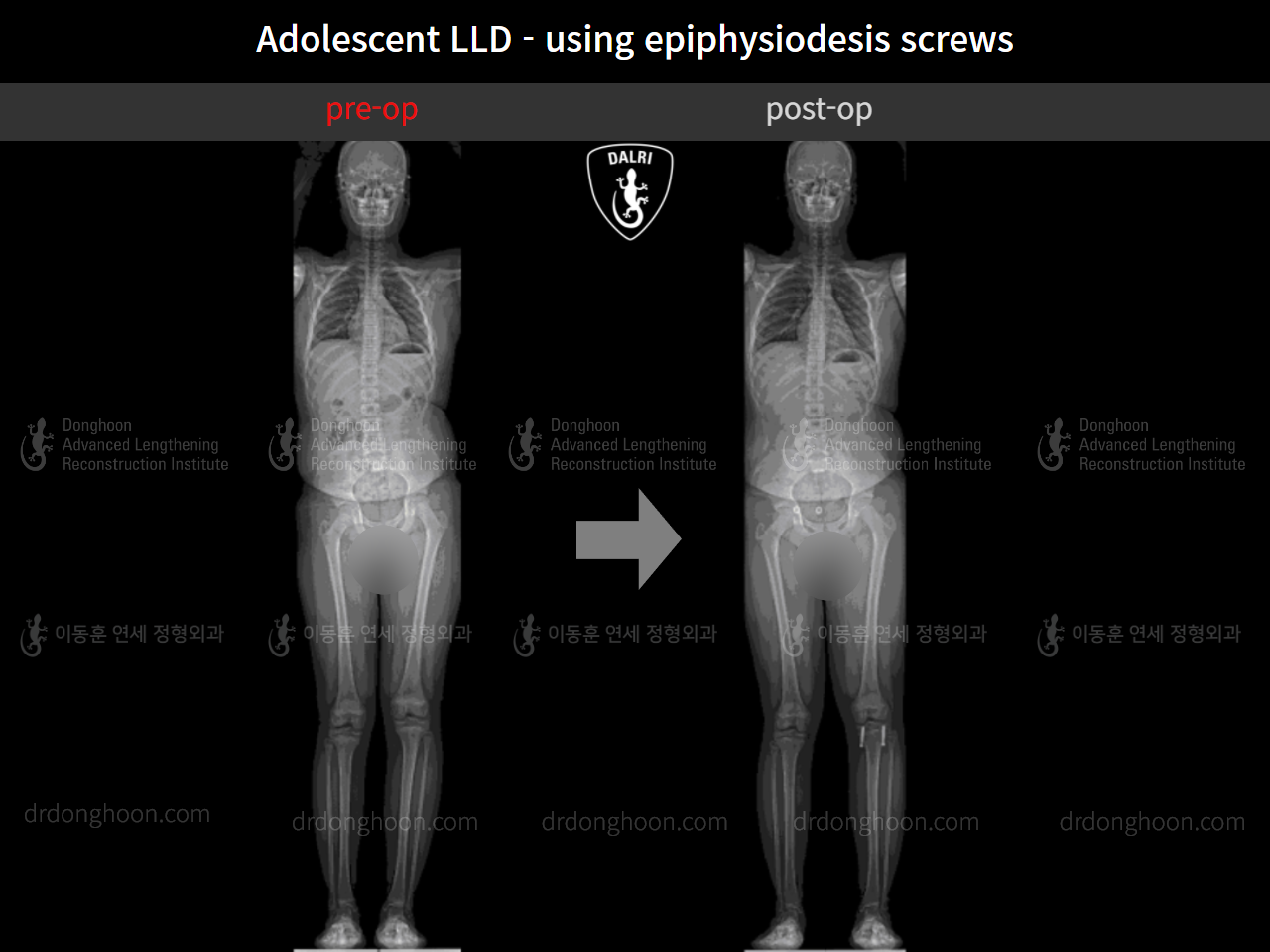 Before and after paediatric & adolescent lld, case 11472870, image 9, Dr. Donghoon institute (DALRI)