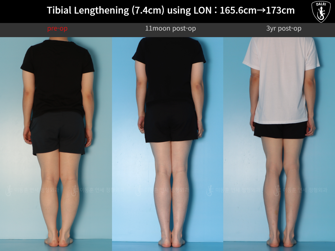 Before and after cll lon, case 125561518, image 2, Dr. Donghoon institute (DALRI)