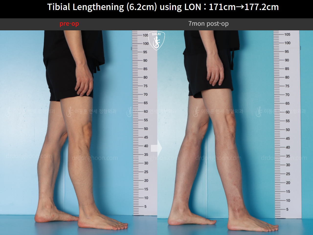 Before and after cll lon, case 16713373, image 11, Dr. Donghoon institute (DALRI)