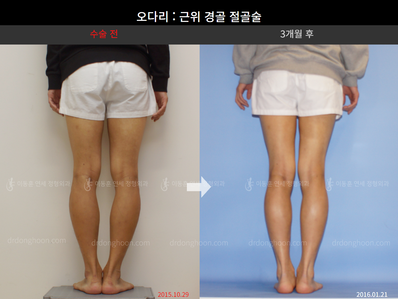 Before and after adult bowlegs, case 4311351, image 4, Dr. Donghoon institute (DALRI)