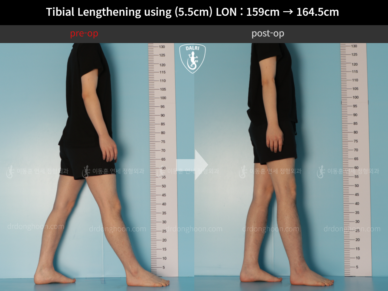 Before and after cll lon, case 11747999, image 3, Dr. Donghoon institute (DALRI)