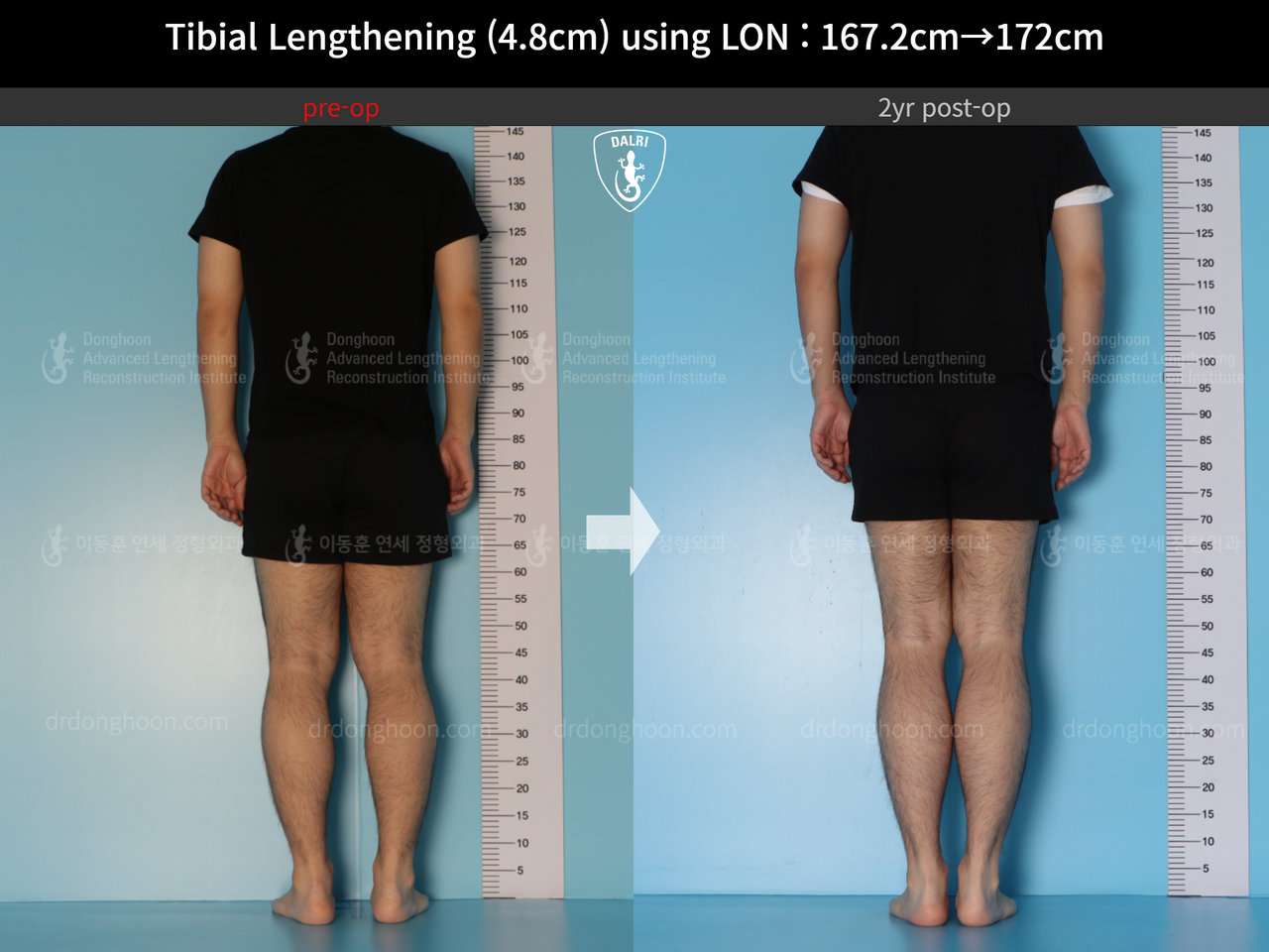 Before and after cll lon, case 14418932, image 2, Dr. Donghoon institute (DALRI)