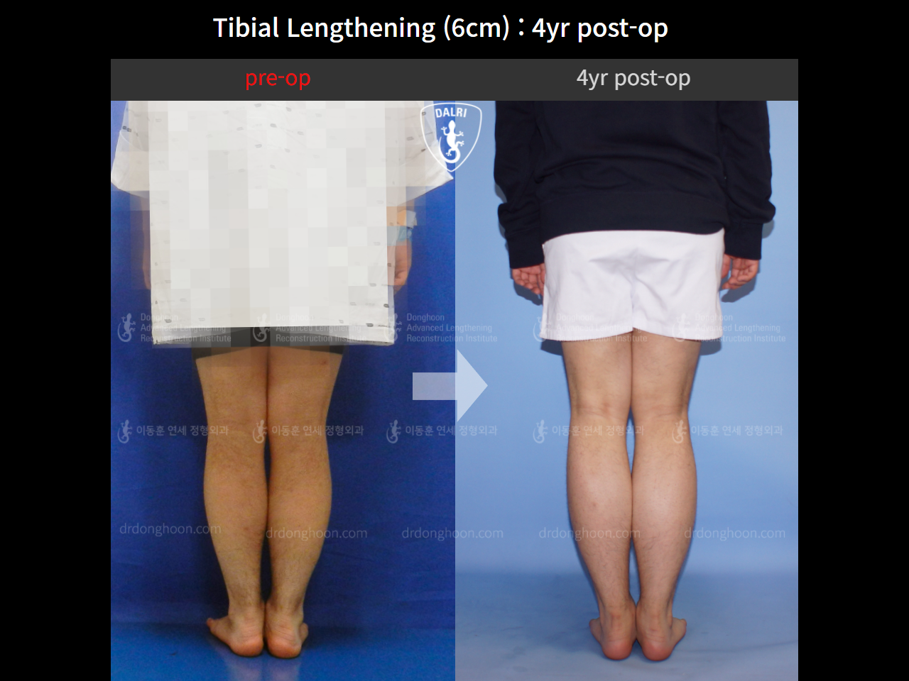 Before and after cll lon, case 10474212, image 5, Dr. Donghoon institute (DALRI)