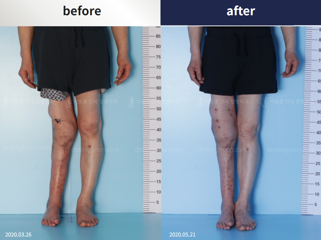 Before and after congenital condition, case 4304680, image 1, Dr. Donghoon institute (DALRI)