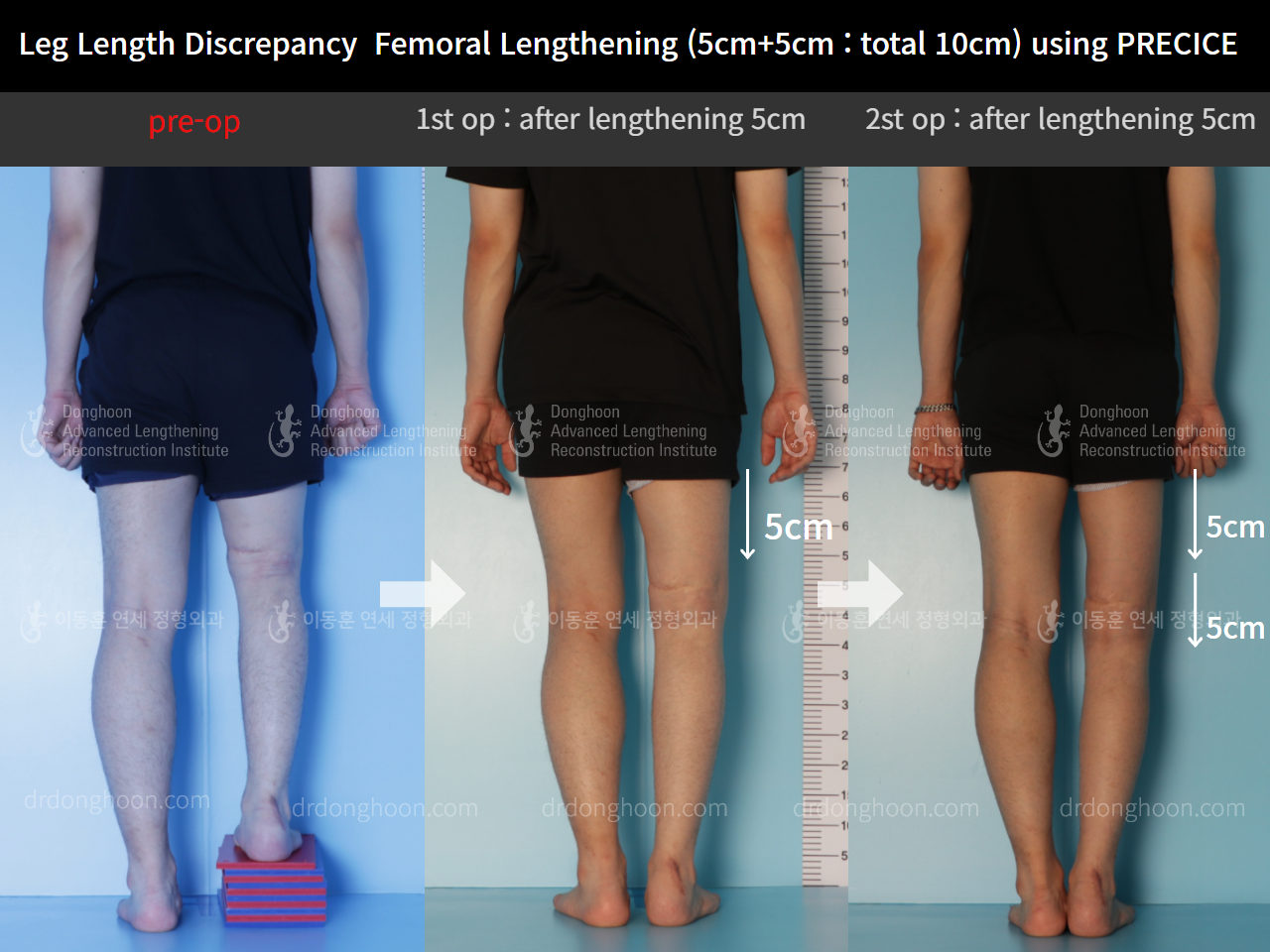 Before and after adult lld, case 9100401, image 2, Dr. Donghoon institute (DALRI)