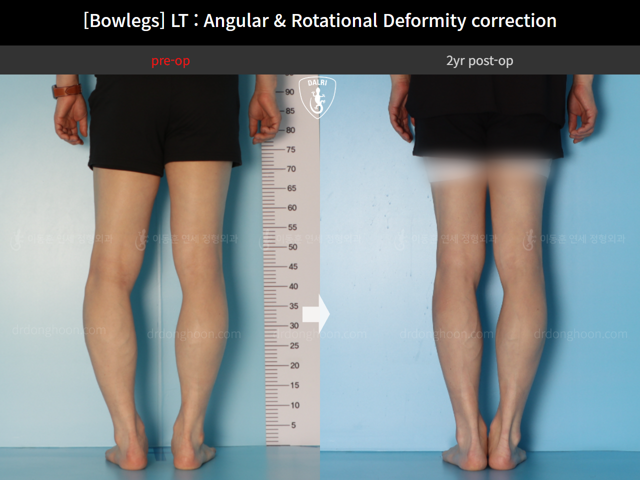 Before and after adult bowlegs, case 15111863, image 7, Dr. Donghoon institute (DALRI)