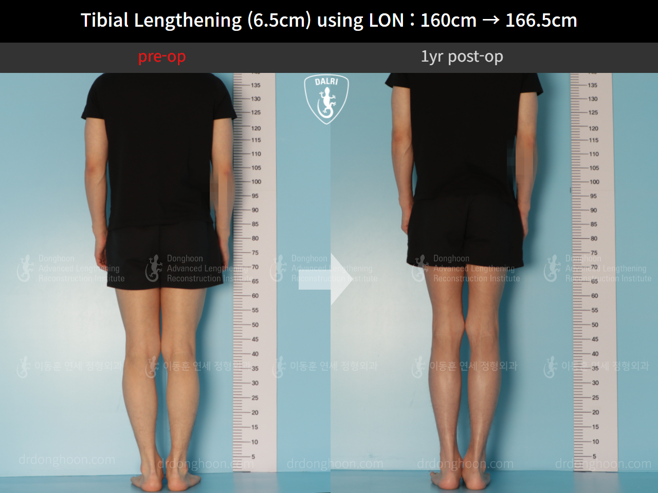 Before and after cll lon, case 10293105, image 2, Dr. Donghoon institute (DALRI)