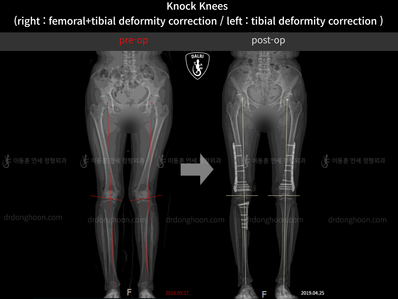 Before and after adult knock knees, case 13229486, image 3, Dr. Donghoon institute (DALRI)
