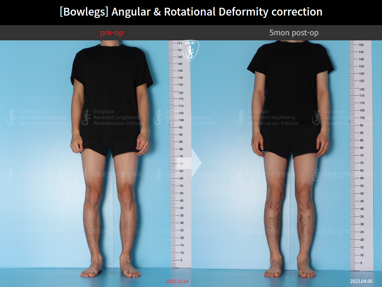 Before and after adult bowlegs, case 14707617, image 2, Dr. Donghoon institute (DALRI)