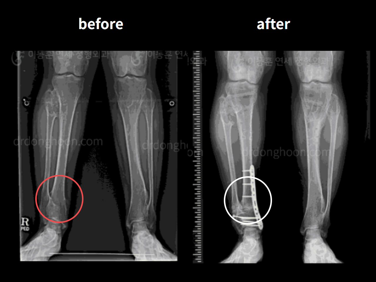 Before and after foot & ankle deformity, case 4248128, image 3, Dr. Donghoon institute (DALRI)