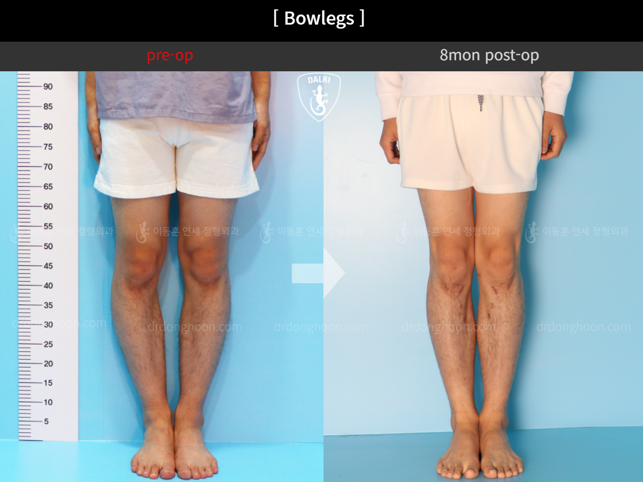 Before and after adult bowlegs, case 4311053, image 5, Dr. Donghoon institute (DALRI)