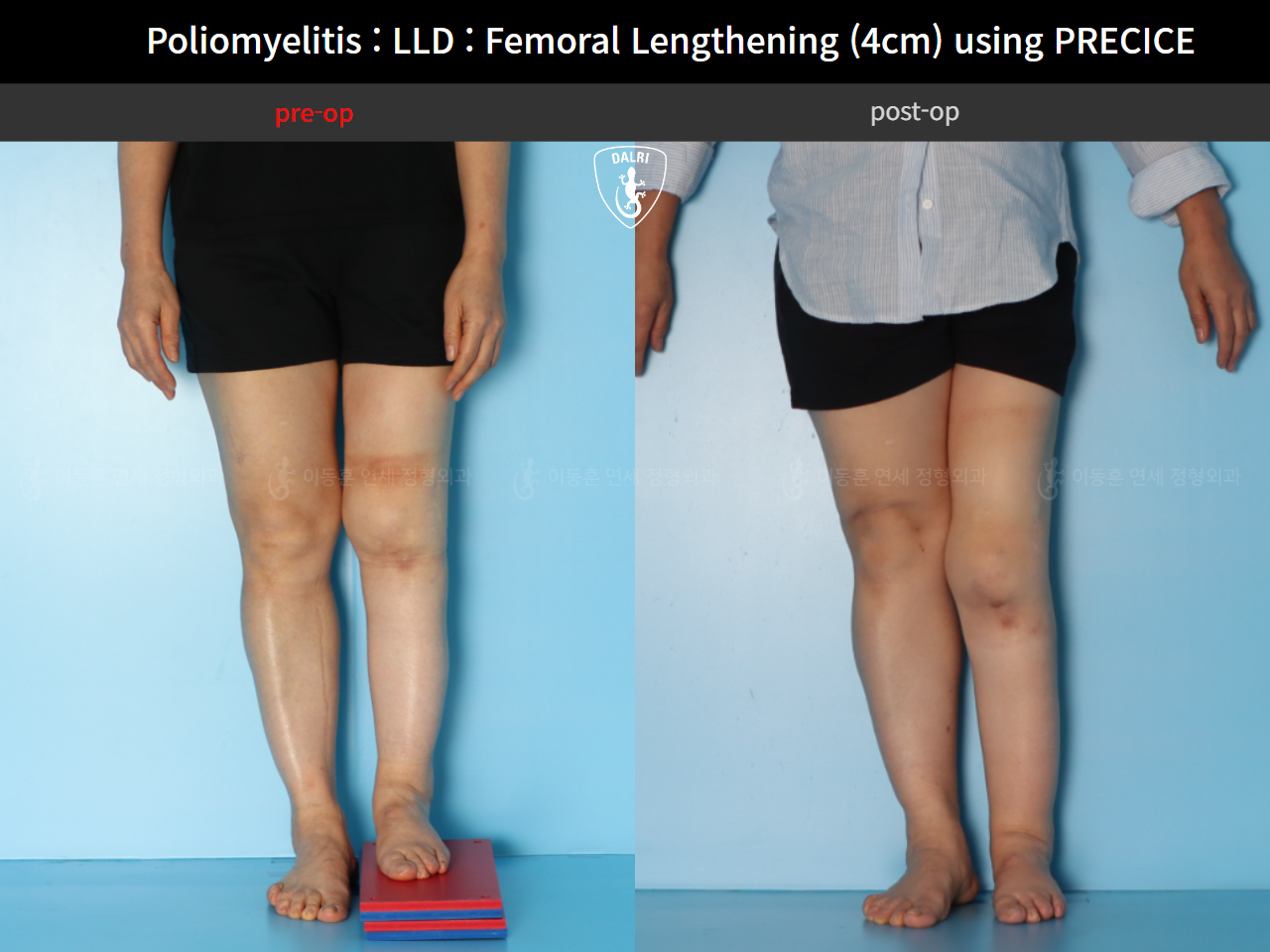 Before and after congenital condition, case 91244014, image 4, Dr. Donghoon institute (DALRI)